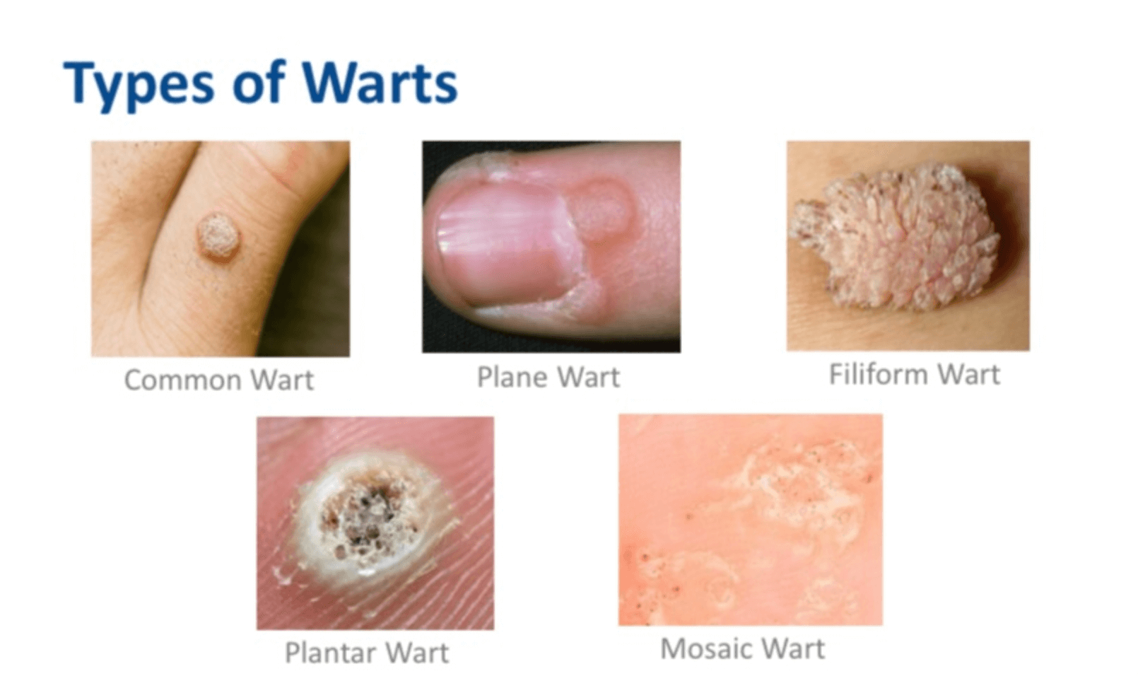 Wart Laser Therapy