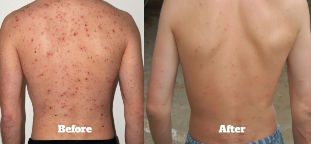 Male Back Acne Facial