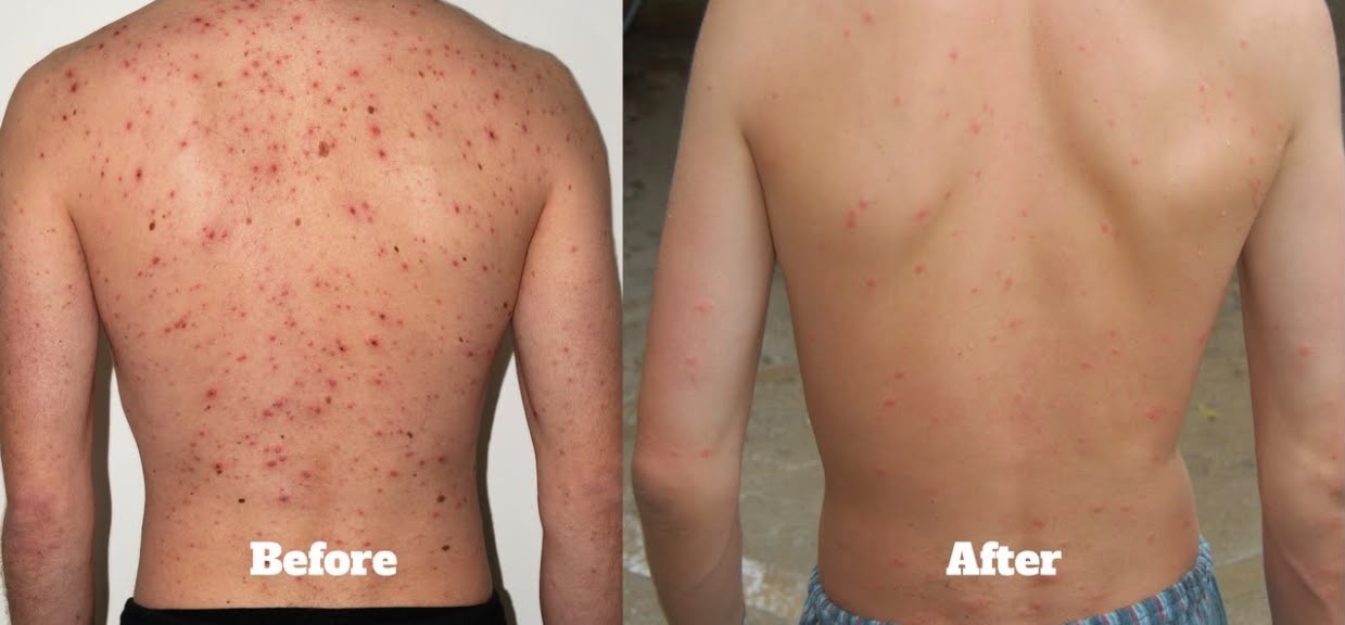 Male Back Acne Facial